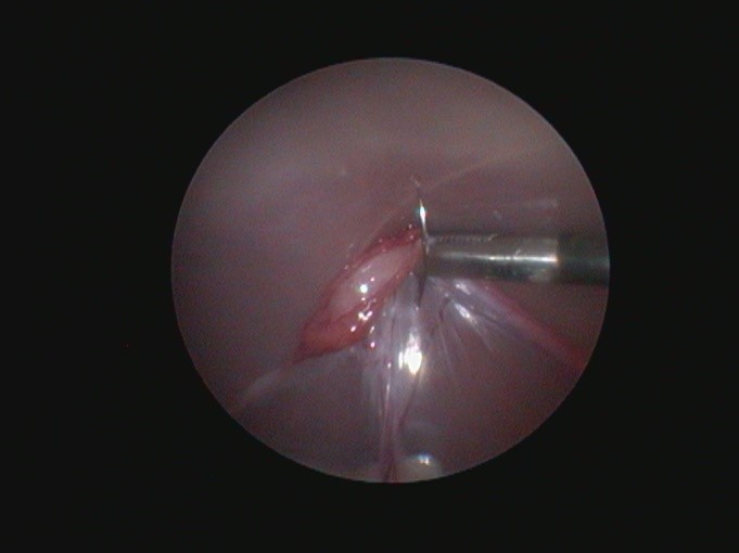 лапароскопия