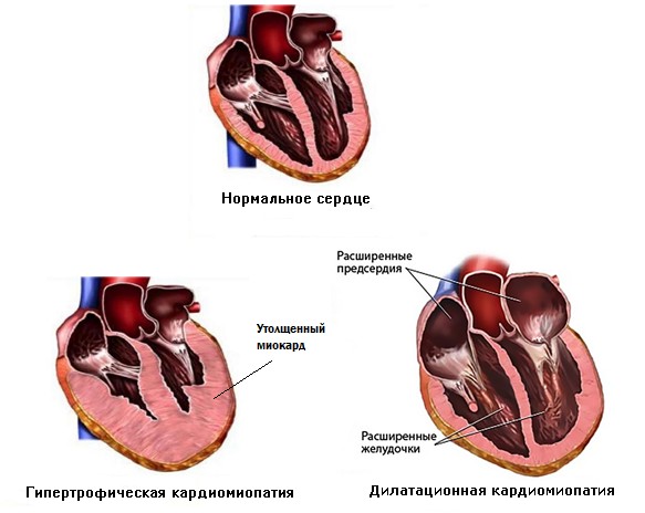 Заболевания сердца у кошек. Кардиомиопатии. ГКМП и ДКМП что это?