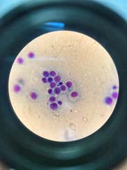 гистиоцитома