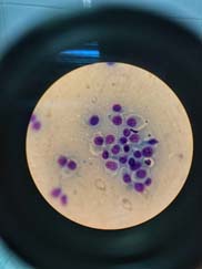 гистиоцитома