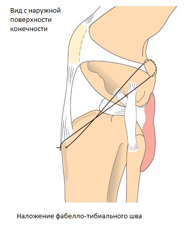 Свой Доктор. Статья для Владельцев. Разрыв передней крестовидной связки. Какую операцию выбрать?