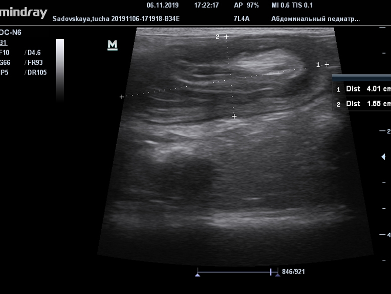 Фото 2. При продольном срезе  -  часть кишечника, в которую внедрен инвагинат (внешние стороны этой пораженной области), утолщенная,  гипоэхогенная.