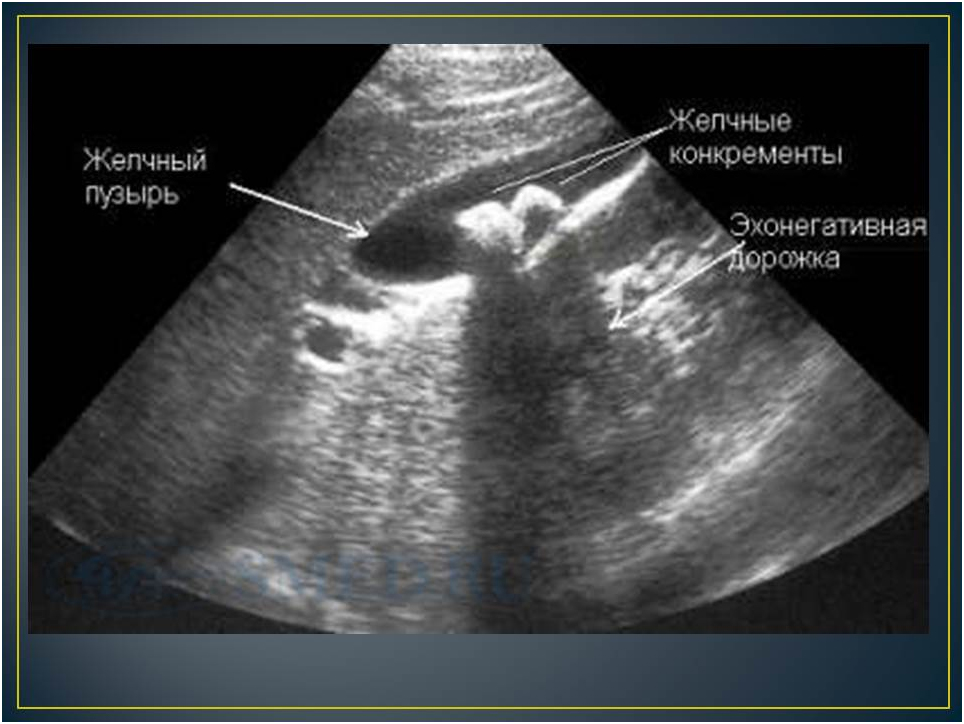 Эхогенный желчный пузырь. Конкременты желчного УЗИ. Конкременты желчного пузыря УЗИ. Конкременты желчного пузыря что это такое. Холестериновые камни в желчном на УЗИ.