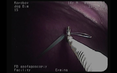 Проведение  направляющей нити через канюлю, захват ее с помощью щипцов для биопсии и выведение ее  через рот с помощью эндоскопа