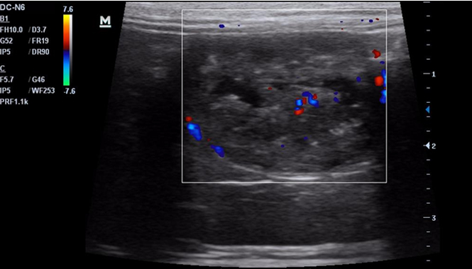 Фото 1в. Объемное образование в области правого рога с доплером.