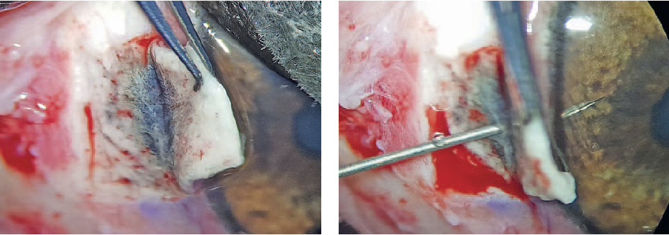 Склеральный лоскут с доступом к трабекулярной зоне (слева), парацентез ПК (справа)