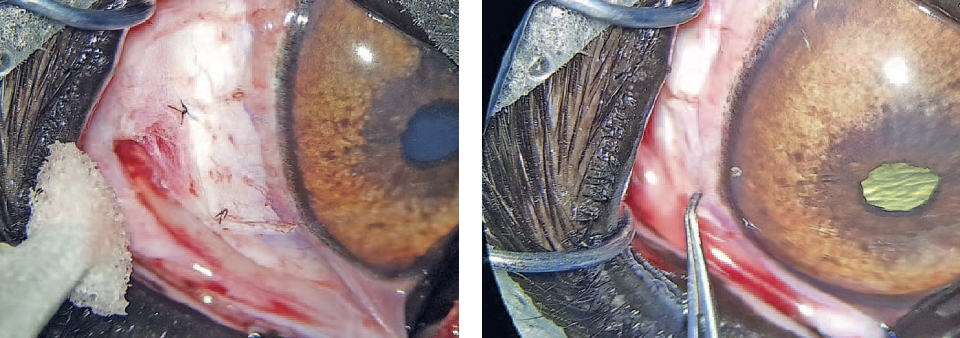 Фиксация склерального лоскута (слева) и ушивание конъюнктивы (справа)