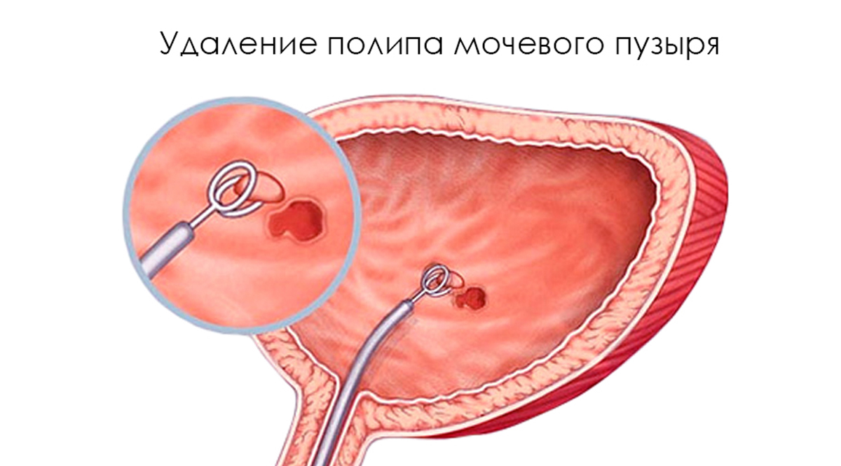 Полип в мочевом пузыре у кошек