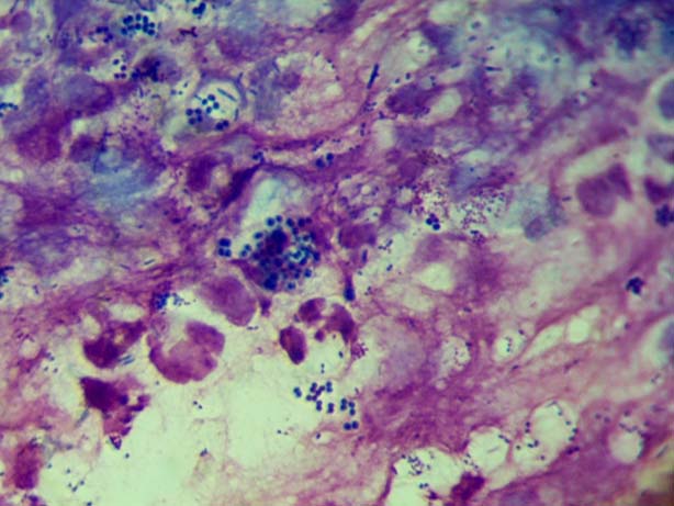 Бактерии и клетки воспаления под микроскопом
